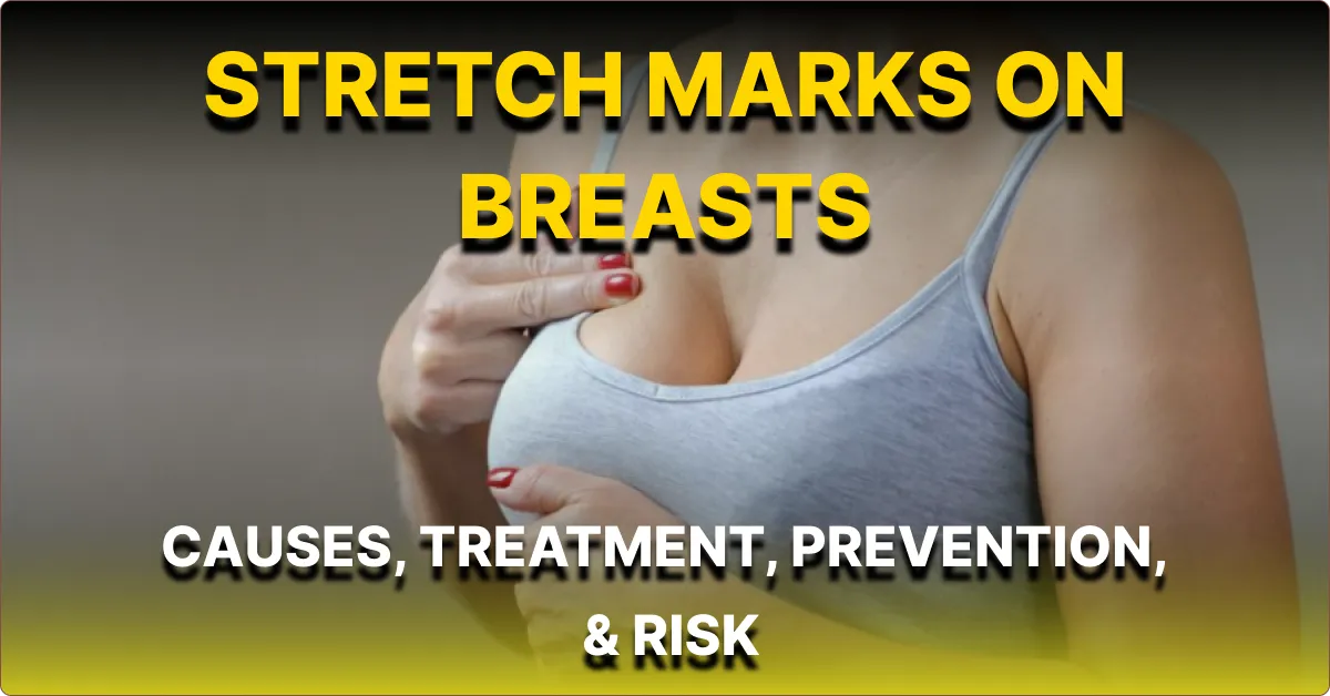Stretch Marks on Breasts, Causes, Treatment, Prevention, & Risk